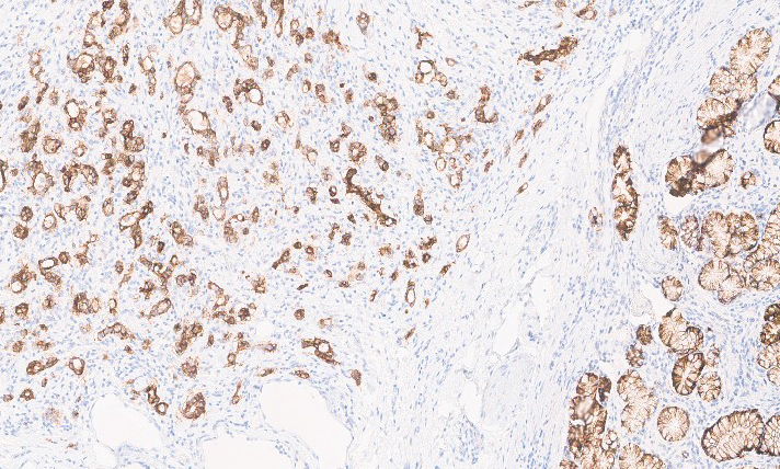 Claudin 18.2 Tumor and Benign